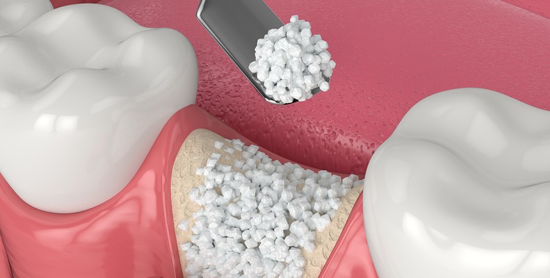 periodontal disease grafting
