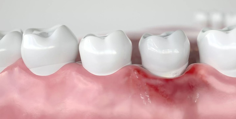 periodontal / gum disease