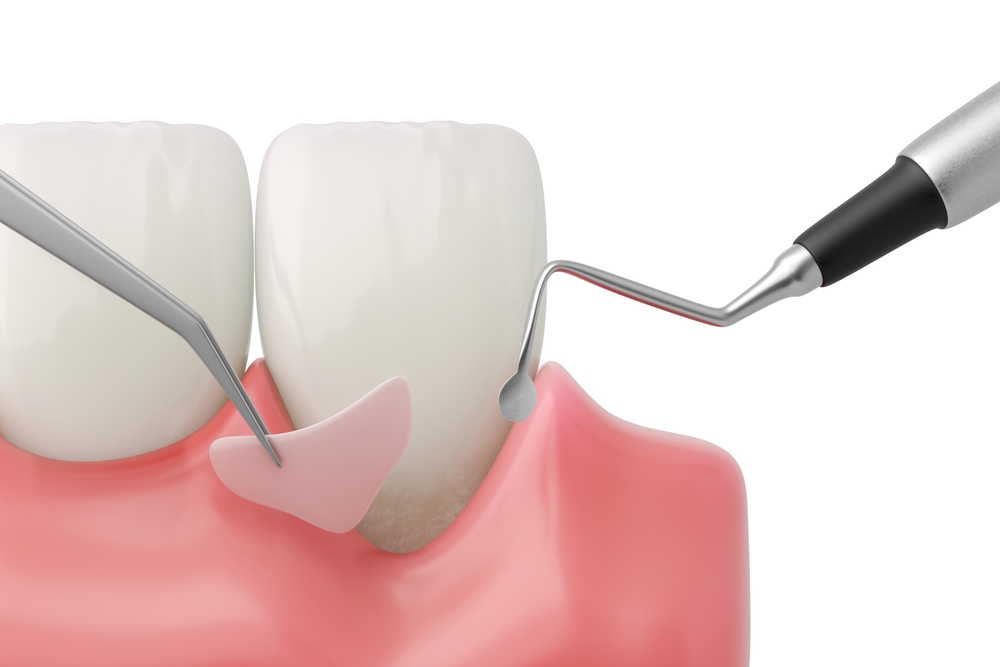 gum grafting surgery